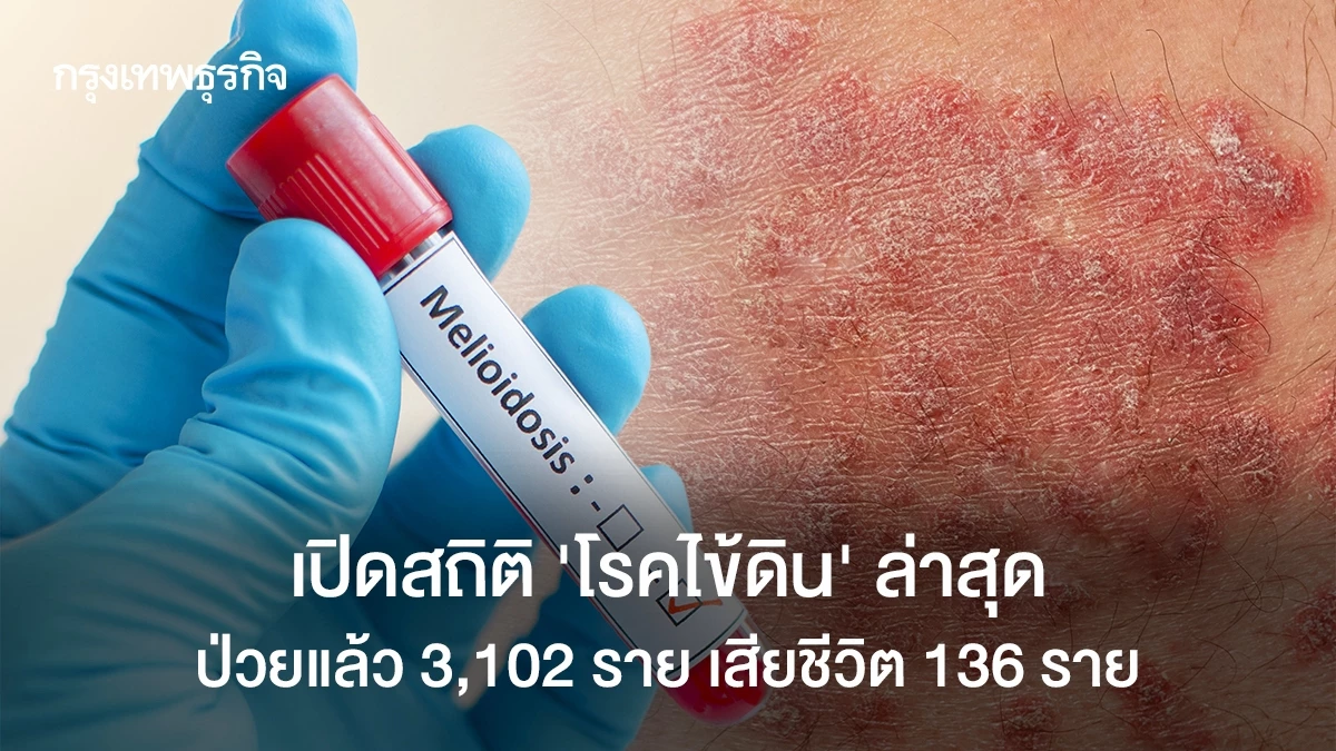 กรมควบคุมโรคเตือนไข้ดินปี 2569 ป่วยแล้ว 3,102 ราย เสียชีวิต 136 ราย พบมากในอีสาน